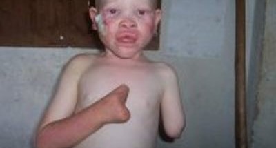 Albinos crimen ritual (7)