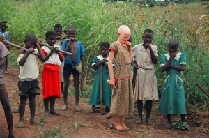 Los niños abandonados o con alguna tara fisica  comoesta niña albina en Malawi son los primeros acusados de brujeria (1)